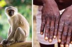شیوع آبله میمون در آمریکا و اروپا/ علائم این بیماری چیست؟